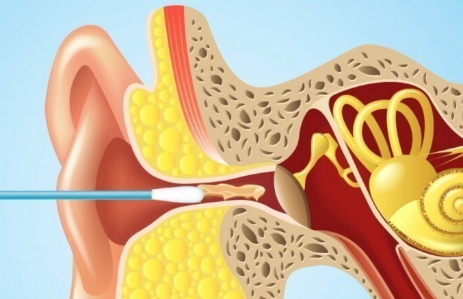 Использование ватных палочек для ушей может привести к их заболеванию