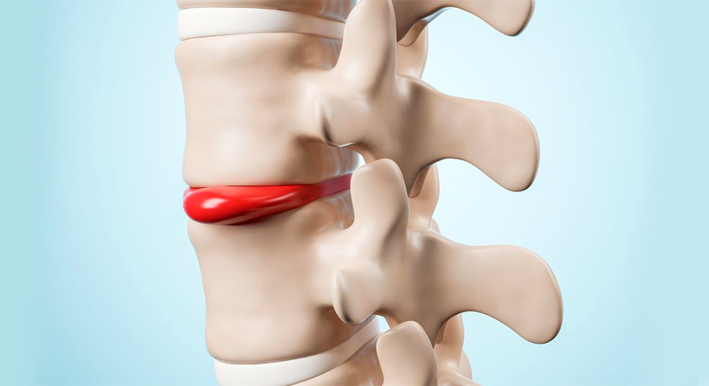 Грыжа межпозвонкового диска: причины появления, лечение и профилактика