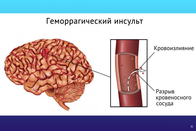 Как организм сигнализирует о приближении инсульта