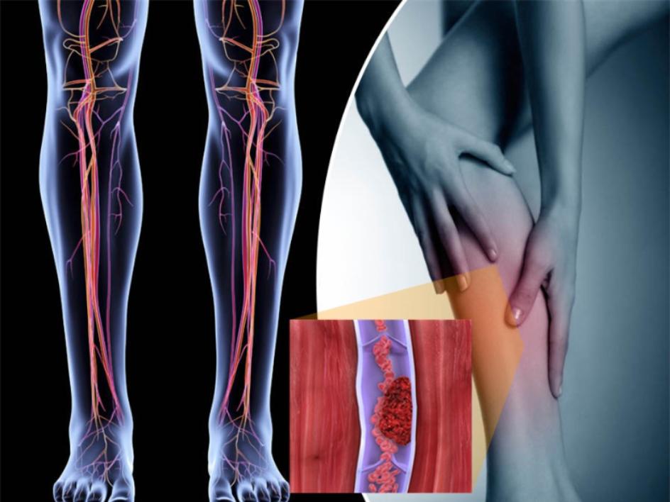 Чем опасен тромбоз, как понять, что вы в группе риска, основные симптомы